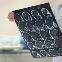 NeurAxis (NRXS) Shares Rise Amid Favorable Reimbursement & Guideline Developments