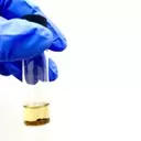 ADC Therapeutics: Downgraded to 'Sell' Amid ZYNLONTA Trial Setbacks